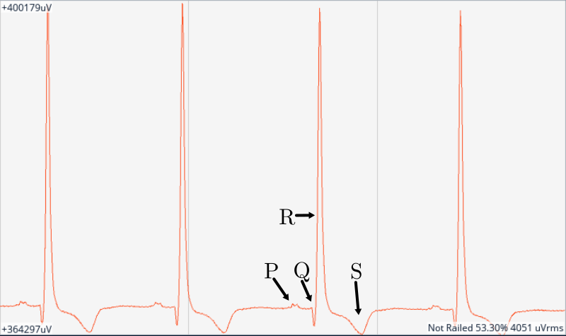 ECG plot recorded with the BioSgnals rev.2 PCB.